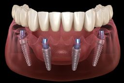 اجزای ایمپلنت دندان چیست؟