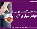 هزینه عمل کیست مویی و عوامل موثر بر آن