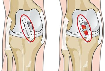 هزینه عمل رباط صلیبی زانو در تهران با بیمه