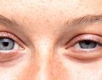 چطور از افتادگی پلک جلوگیری کنیم؟