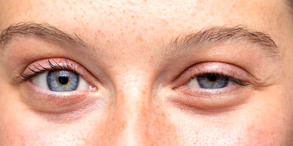 چطور از افتادگی پلک جلوگیری کنیم؟
