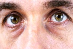 یک روش ساده برای از بین بردن سیاهی زیر چشم