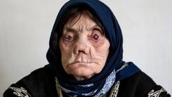 آمار ترسناک مبتلایان جذام در ایران | ۳ نشانه‌ اصلی بیماری