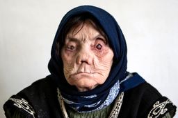 آمار ترسناک مبتلایان جذام در ایران | ۳ نشانه‌ اصلی بیماری