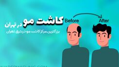 بهترین کلینیک کاشت مو و ابرو در تهران