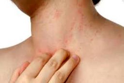 علت خارش پوست در زمستان چیست؟| راه های درمان را بخوانید