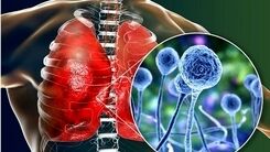  بیماری قارچ سیاه چیست؟+جزئیات بیشتر را بخوانید 