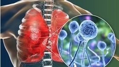 بیماری قارچ سیاه چیست؟+جزئیات بیشتر را بخوانید 