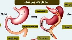 بای پس معده چیست؟