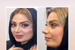 پشیمانی صبا راد بعد از منتشر کردن این عکسش | چهره ترسناک صبا راد بعد از بیرون آمدن از مطب دکتر جراحی زیبایی +عکس