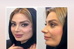 پشیمانی صبا راد بعد از منتشر کردن این عکسش | چهره ترسناک صبا راد بعد از بیرون آمدن از مطب دکتر جراحی زیبایی +عکس