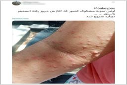  سرایت  هوایی آبله میمونی چقدر است؟