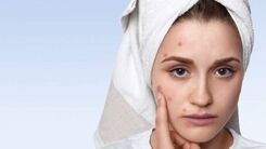 نابودی جوش صورت در یک روز
