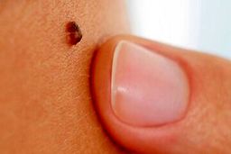 اگر این خال ها را دارید فورا به پزشک مراجعه کنید | کدام خال ها خطرناک هستند ؟