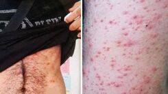 این افراد بیشتر به آبله میمون مبتلا می شوند