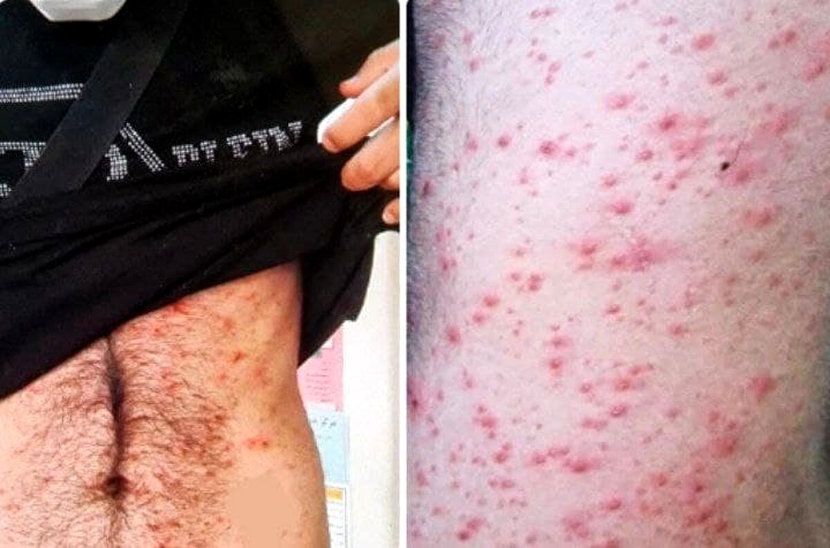 این افراد بیشتر به آبله میمون مبتلا می شوند