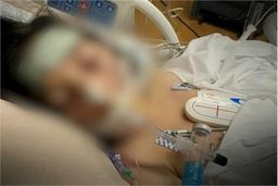 آمار مسمومیت با مشروب تقلبی در کرج بالا رفت | مرگ ۱۲ نفر ؛ ۴ نفر زیر دستگاه تنفس مصنوعی