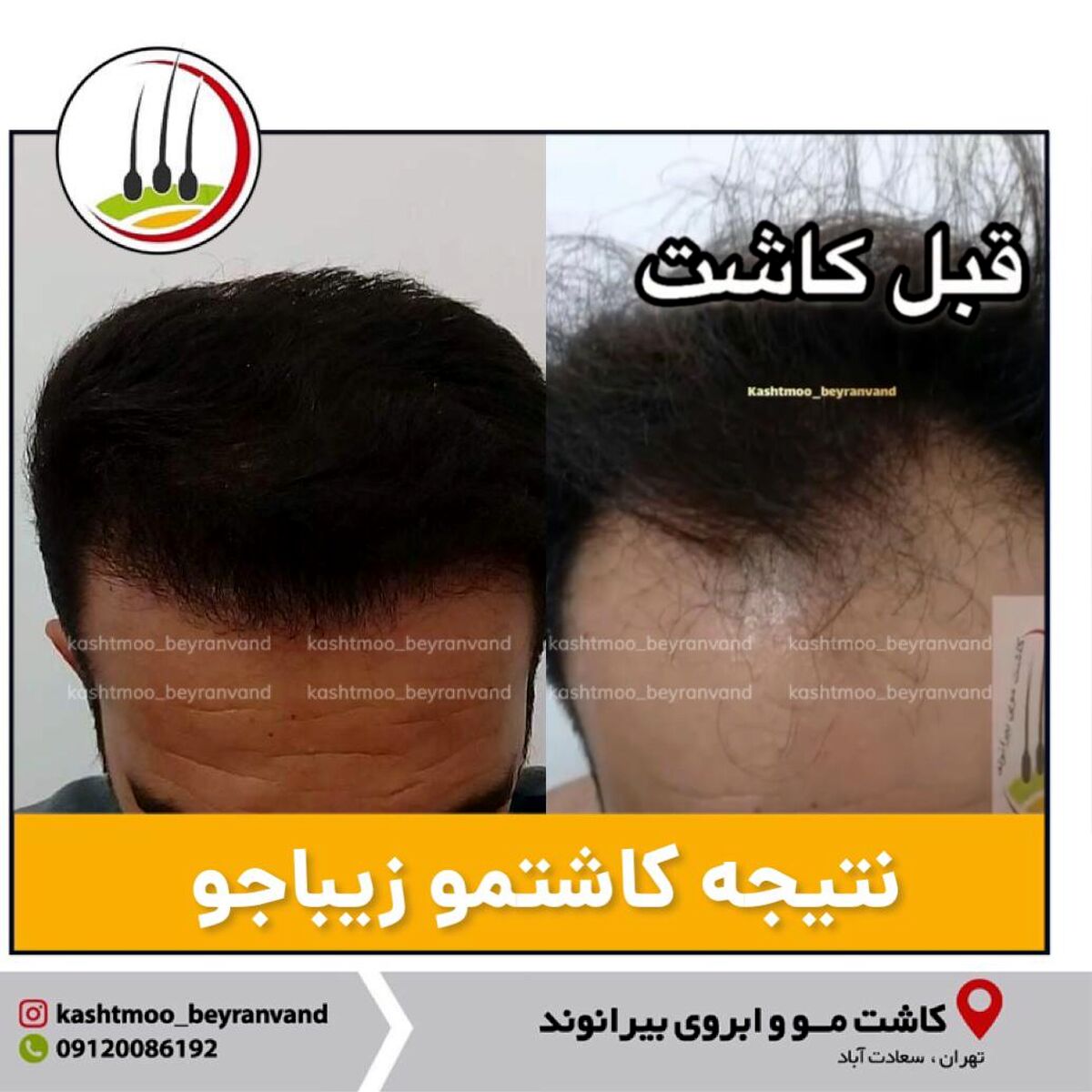 کاشت مو با تکنیک های جدید