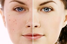 درمان فوری جوش صورت!