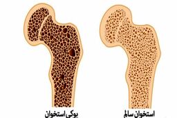 برای پوکی استخوان چی بخوریم؟
