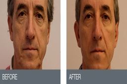 معرفی لیفت با نخ