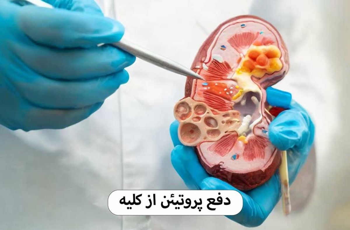 درمان سریع و خانگی دفع پروتئین از کلیه در طب سنتی با عسل