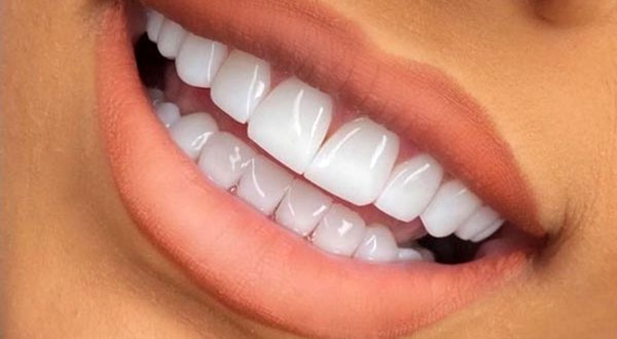 آشنایی با پارامترهای موثر بر هزینه کامپوزیت دندان