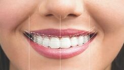 دندانپزشکی زیبایی و تاثیرات ان در طرح لبخند