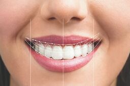 دندانپزشکی زیبایی و تاثیرات ان در طرح لبخند