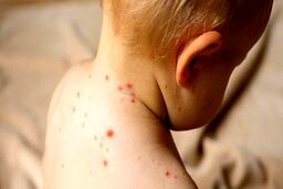 ویروس‌های زمستانی در حال بازگشت | شش ویروس خطرناک در کمین کودکان + راه های پیشگیری