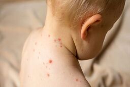 ویروس‌های زمستانی در حال بازگشت | شش ویروس خطرناک در کمین کودکان + راه های پیشگیری