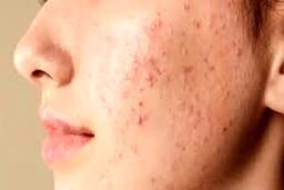 اگر صورتتان پُر جوش و آکنه است بخوانید | این ویتامین برای جوش و آکنه معجزه می‌کند
