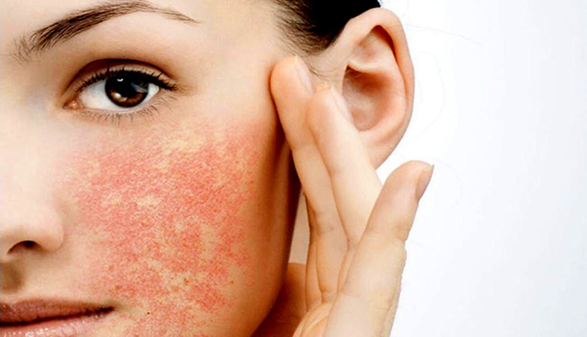 شیوع بیماری پوستی جدید به خاطر ریزگردها+ روش های پیشگیری