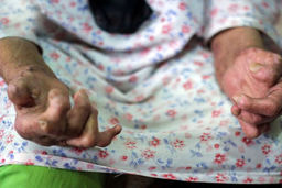 شیوع بیماری خطرناک در ایران پس از چند دهه | هشدار ها را جدی بگیرید 