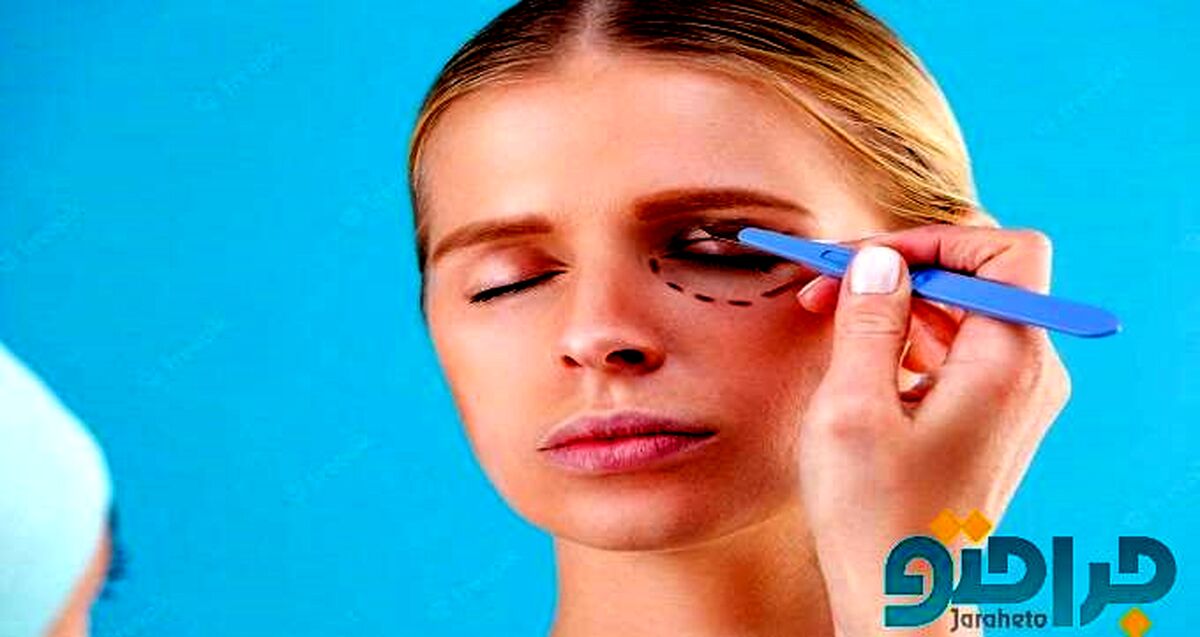 هزینه جراحی بلفاروپلاستی در سال 1401 چقدر است ؟