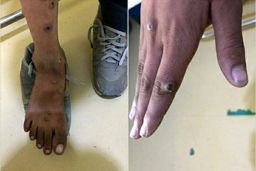 آبله میمون دراصفهان| شناسایی چند مورد مشکوک 